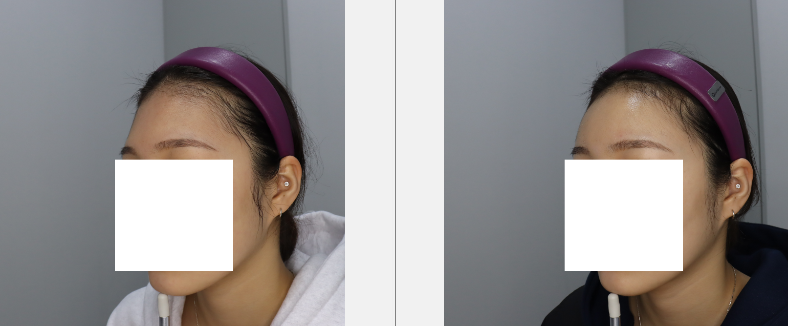 이마+관자 필러 하고 나서 얼굴 인상이 진짜 확 달라졌어요.