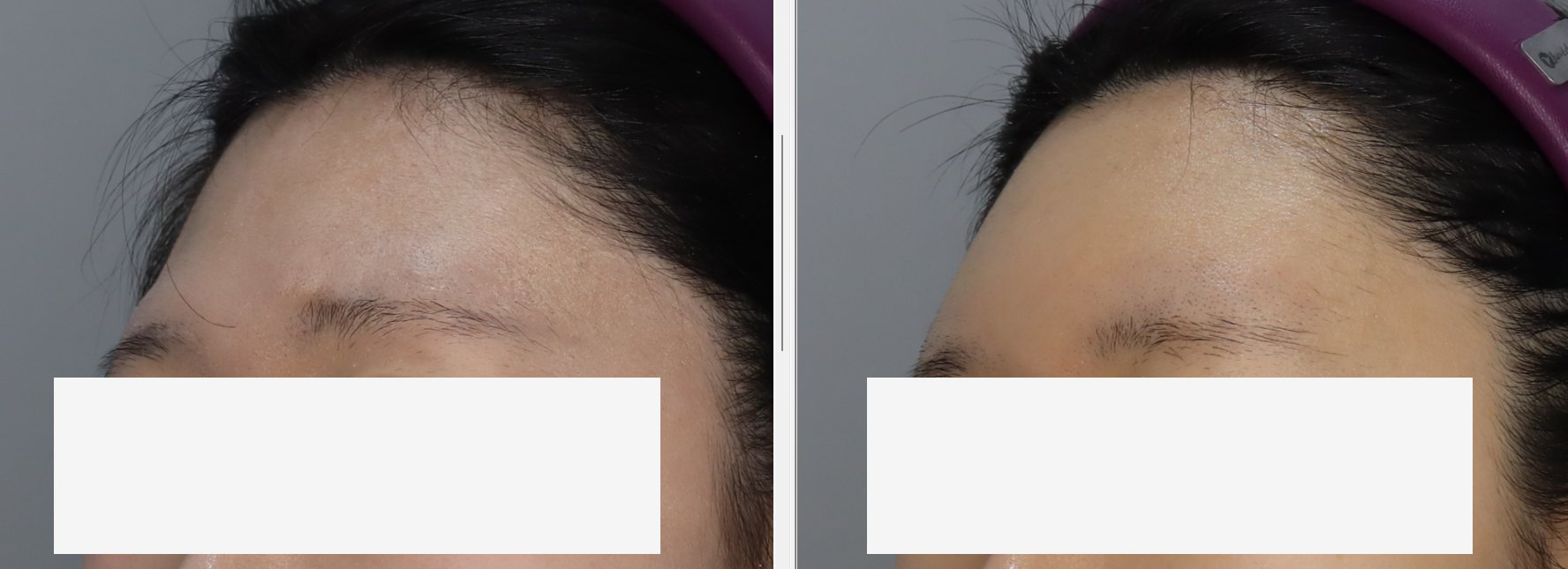 이마 필러 9cc 맞고 후기 !