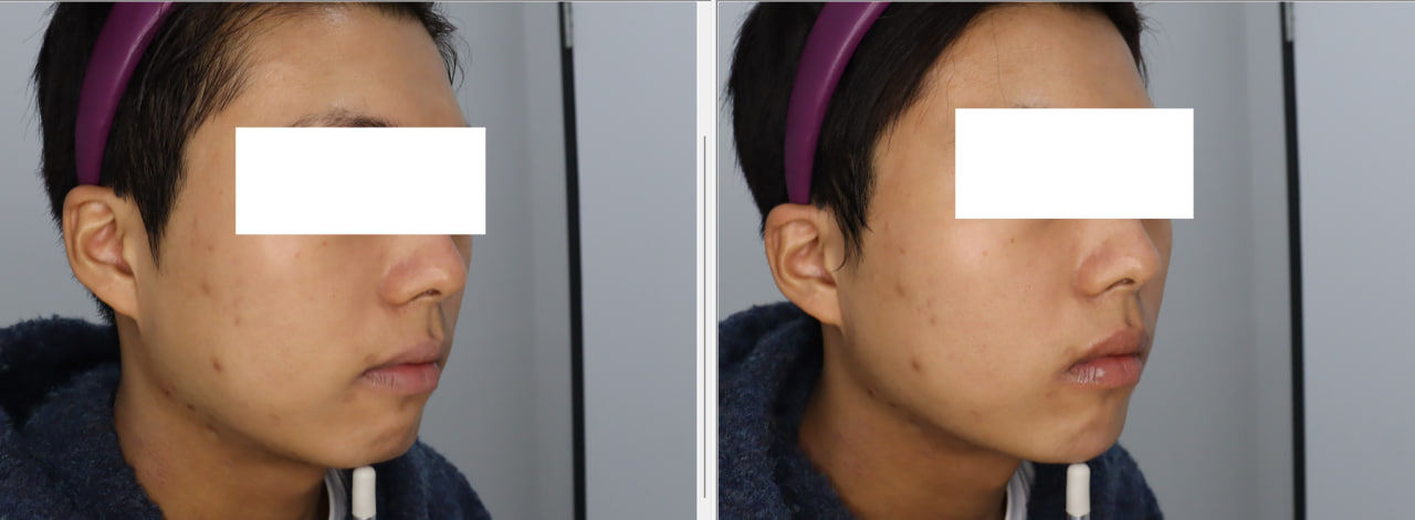 턱끝필러, 자갈턱 보톡스 시술했습니다.