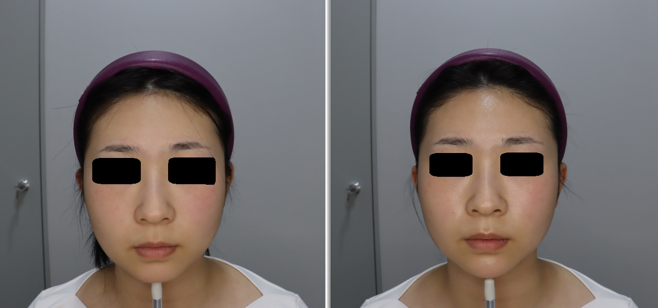 볼살 스트레스로 미미썸에서 리니어지랑 턱끝필러 했어요.