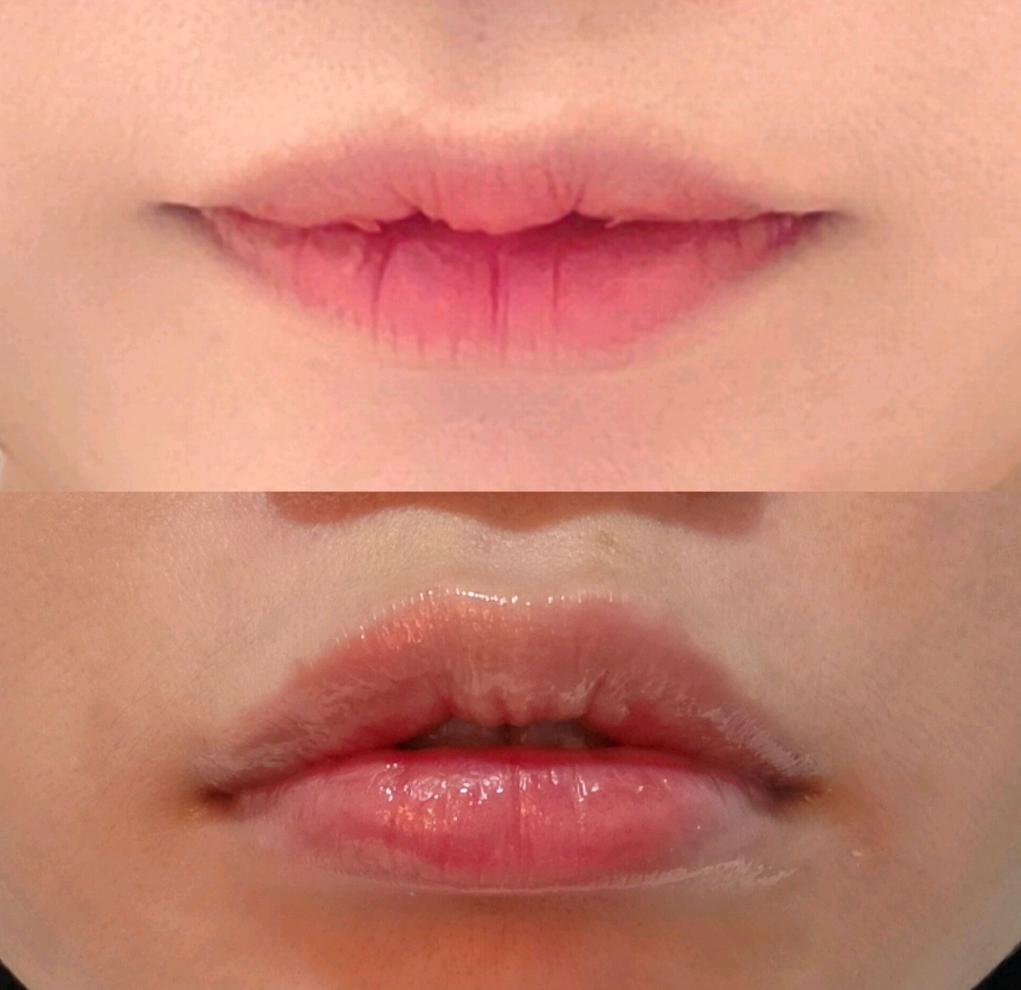 입술필러 후기에용!!