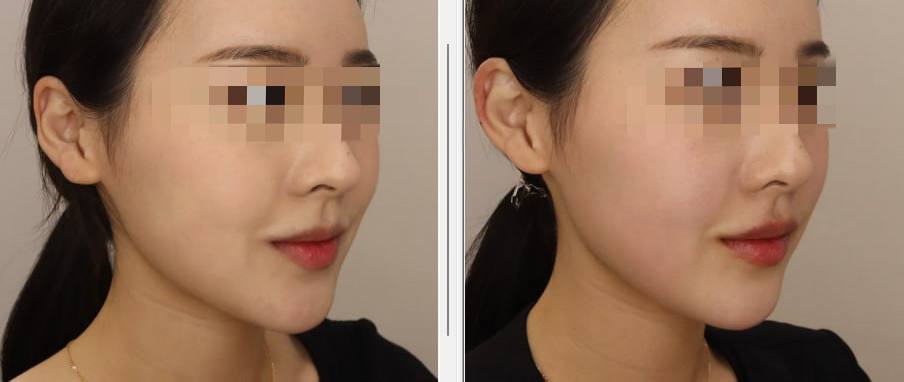 정말 솔직한 귀필러, 윗입술 리얼 후기