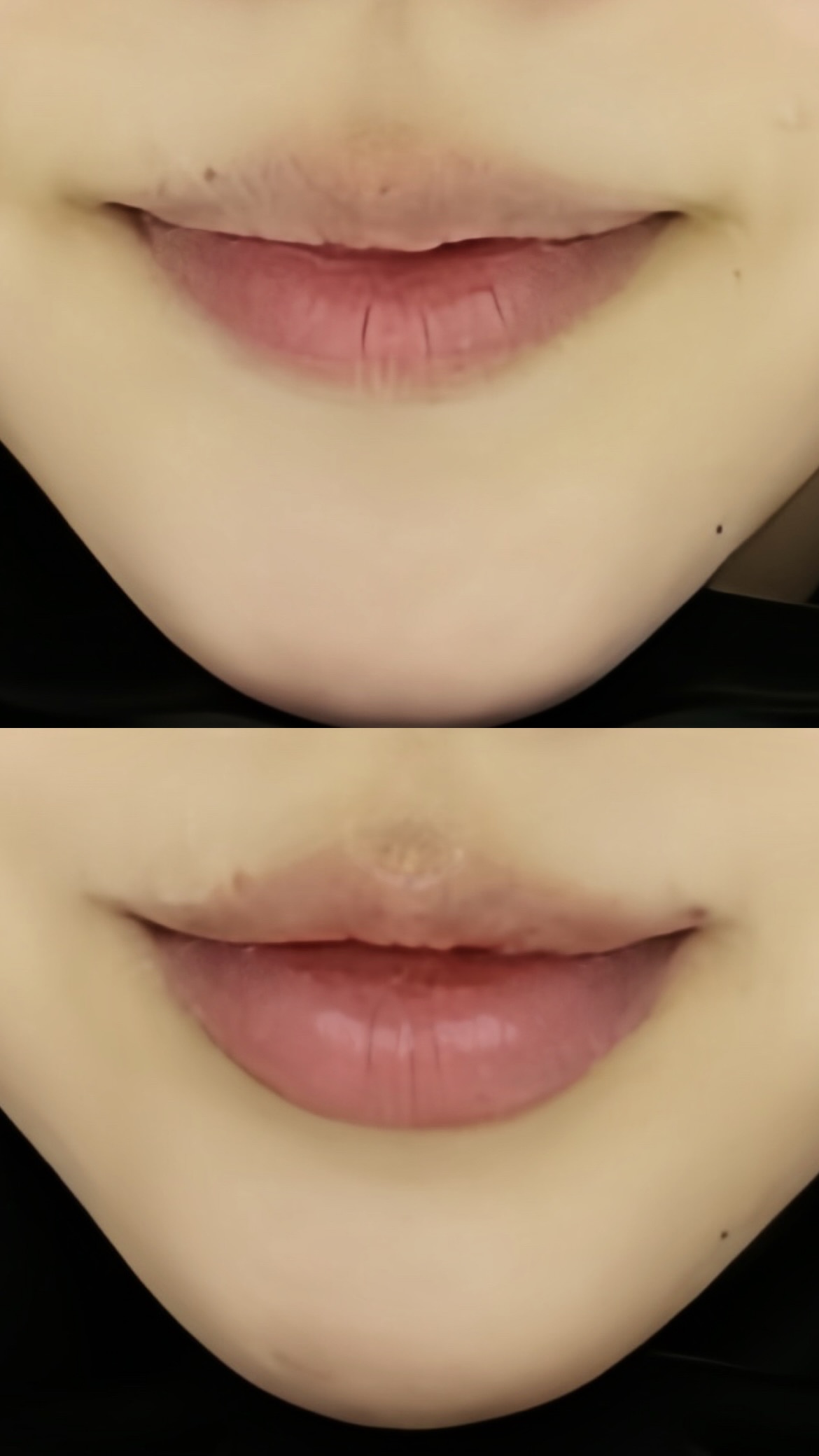 입술필러 후기