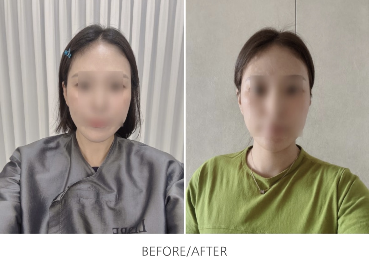 온다리프팅 받고온 후기