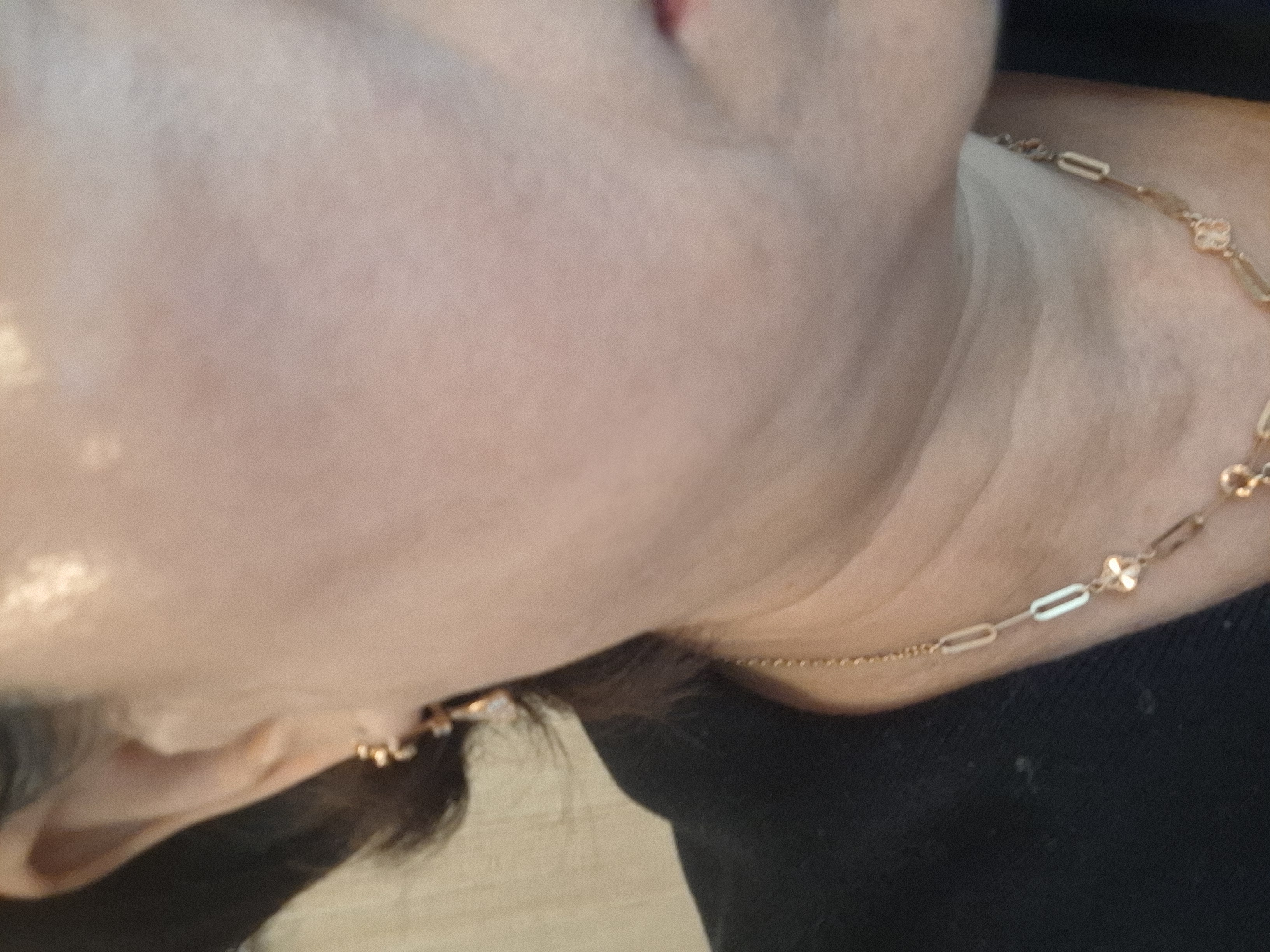 실리프팅 후 죽고싶네요